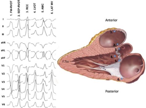 idiopathic ventricular arrhythmia left side.